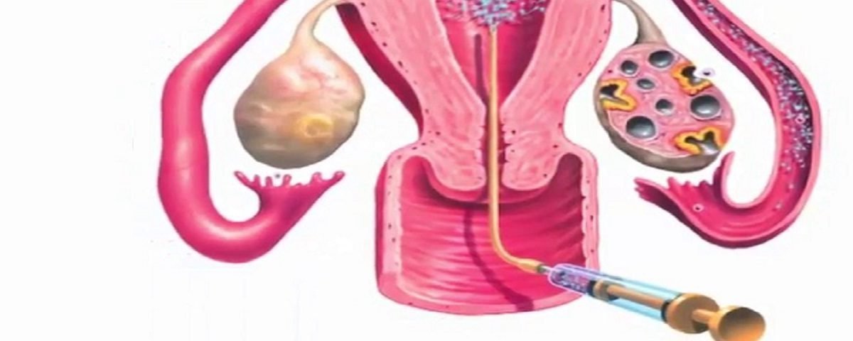 आई.यू.आई.