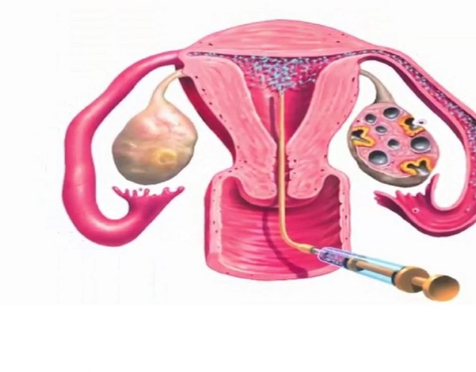 आई.यू.आई.