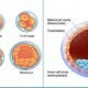 Blastocyst culture and transfer